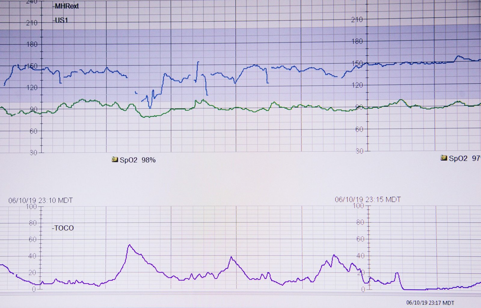 Before-and-after chart illustrating weight loss progress due to better sleep